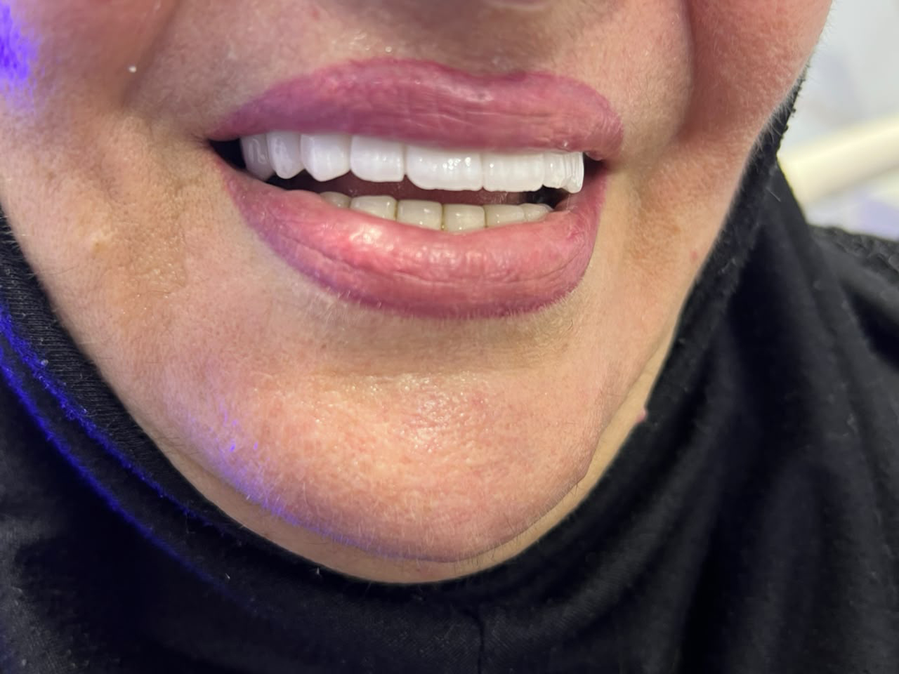 Implant case