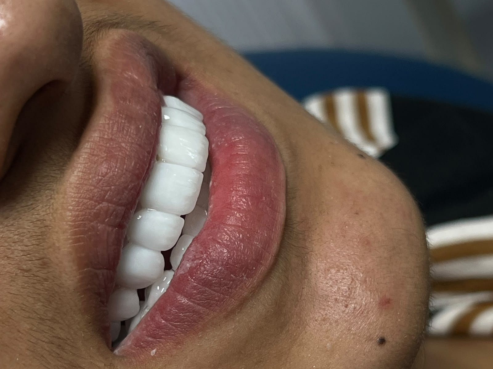 Smile case 1